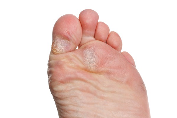 foot-problems-corns_calluses