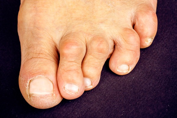 foot-problems-hammertoes